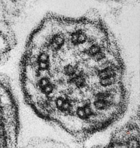 F,5y. | immotile cilia syndrome - nasal mucosa F,5y. | immotile cilia syndrome - nasal mucosa